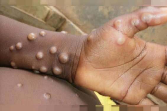 Mpox : l’OMS déclenche son plus haut niveau d’alerte mondiale