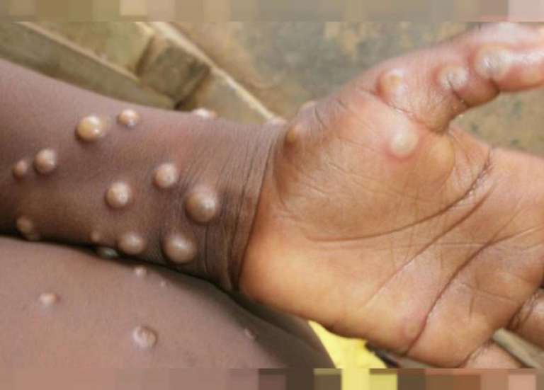 Mpox : l’OMS déclenche son plus haut niveau d’alerte mondiale